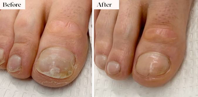 toenail fungus removal before after